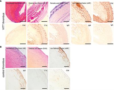 Insights Into Immunothrombotic Mechanisms in Acute Stroke due to Vaccine-Induced Immune Thrombotic Thrombocytopenia